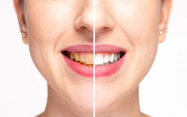 Teeth Whitening Milton Keynes Wolverhampton