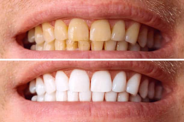 Laser White For Ever Bright – Get a Brighter, Whiter Smile with LA Teeth Whitening Wolverhampton