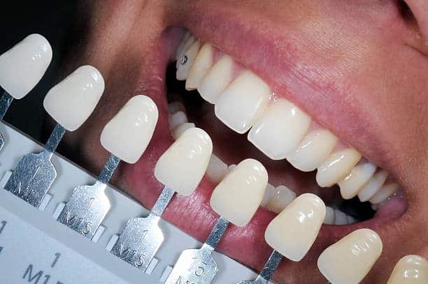 Get Natural and Stunning Smile with Teeth Whitening Results from LA Teeth Whitening Wolverhampton