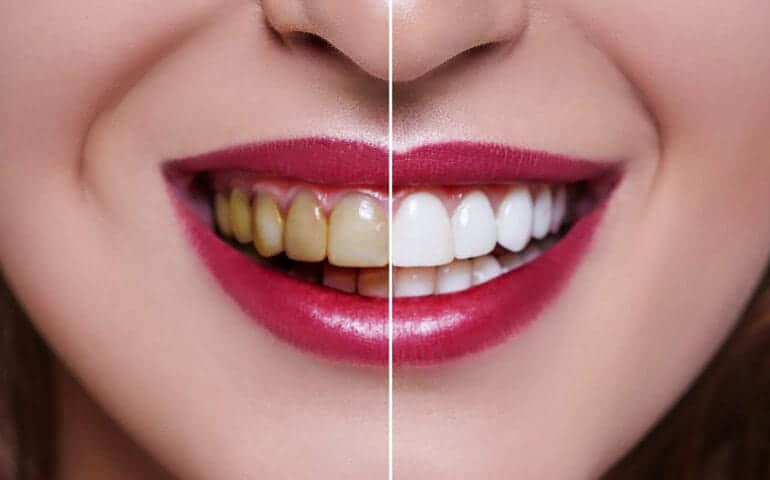 Teeth Whitening Ascot Windsor Wolverhampton