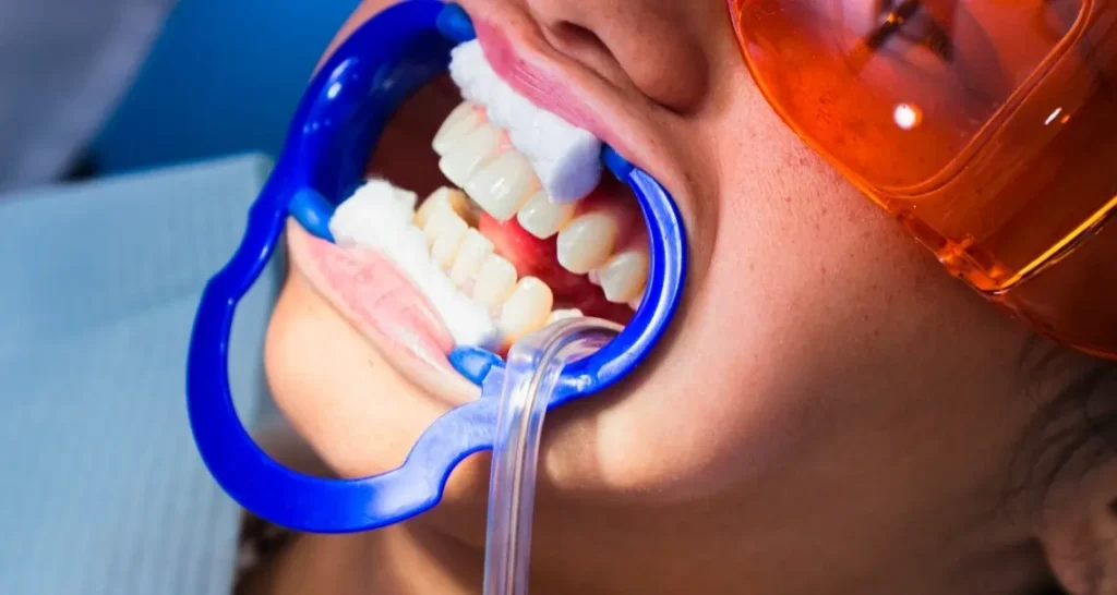 Illustration of teeth with surface-level yellow and brown stains caused by coffee and tobacco Wolverhampton