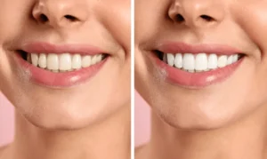 Smiling person undergoing Laser Teeth Whitening for a brighter smile Wolverhampton