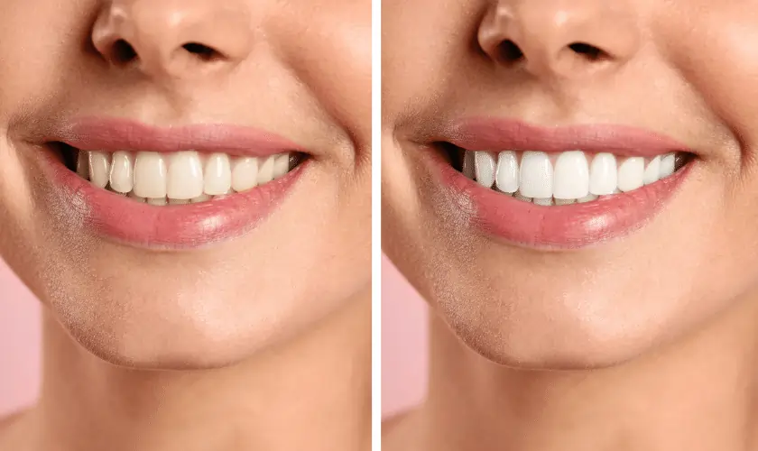 Smiling person undergoing Laser Teeth Whitening for a brighter smile Wolverhampton