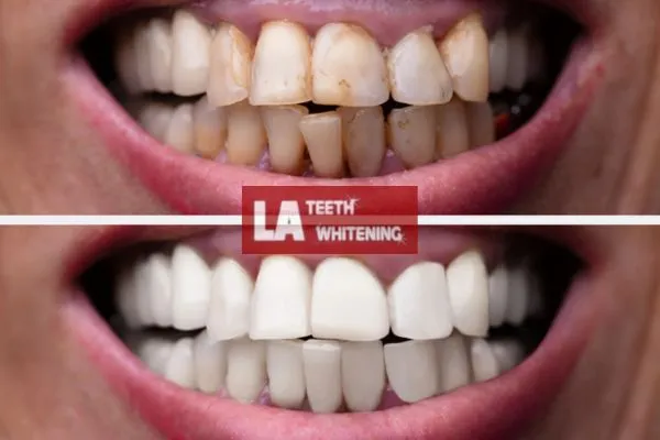 Before-and-after teeth whitening results using a home laser system Wolverhampton
