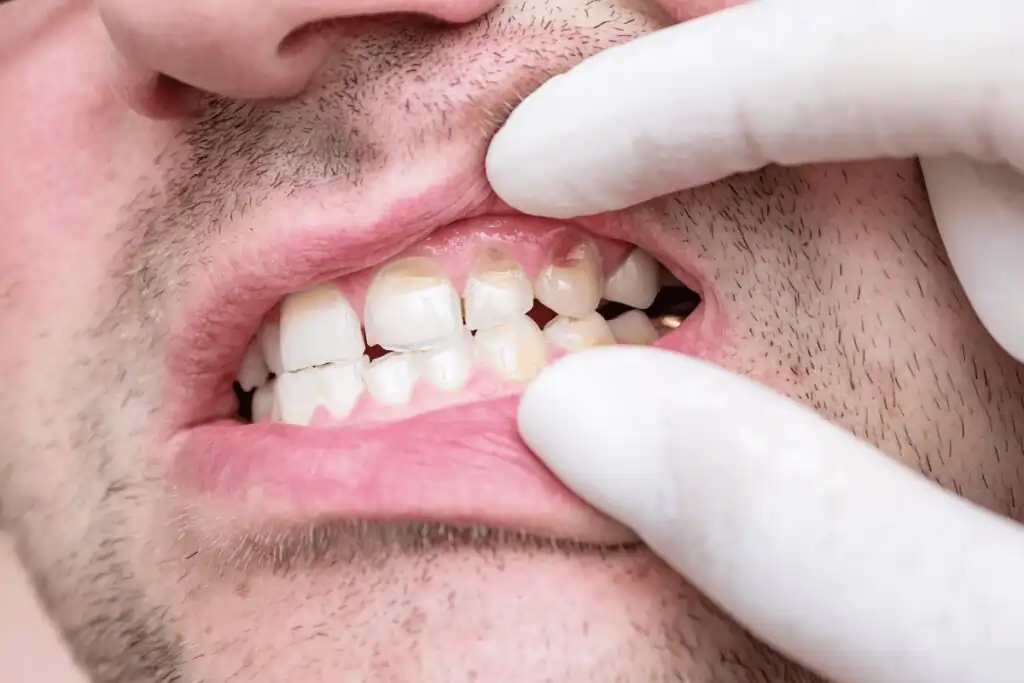 does teeth whitening weaken the teeth Wolverhampton